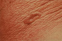 pic_basal_cell_carcinoma_2