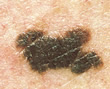 pic_malignant_melanoma